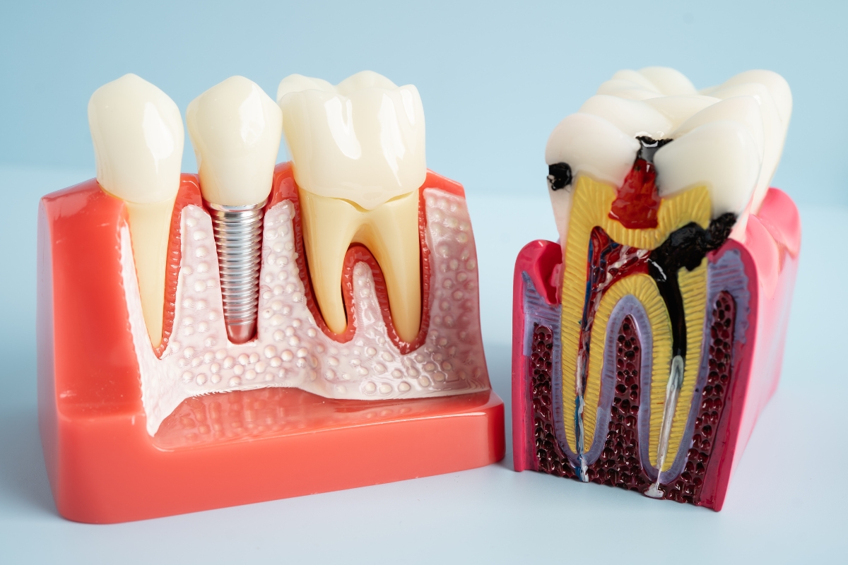 Care for Your New Dental Implants