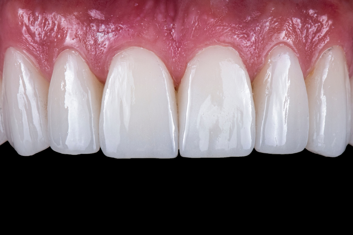 porcelain-veneers-in-Oklahoma-City-OK